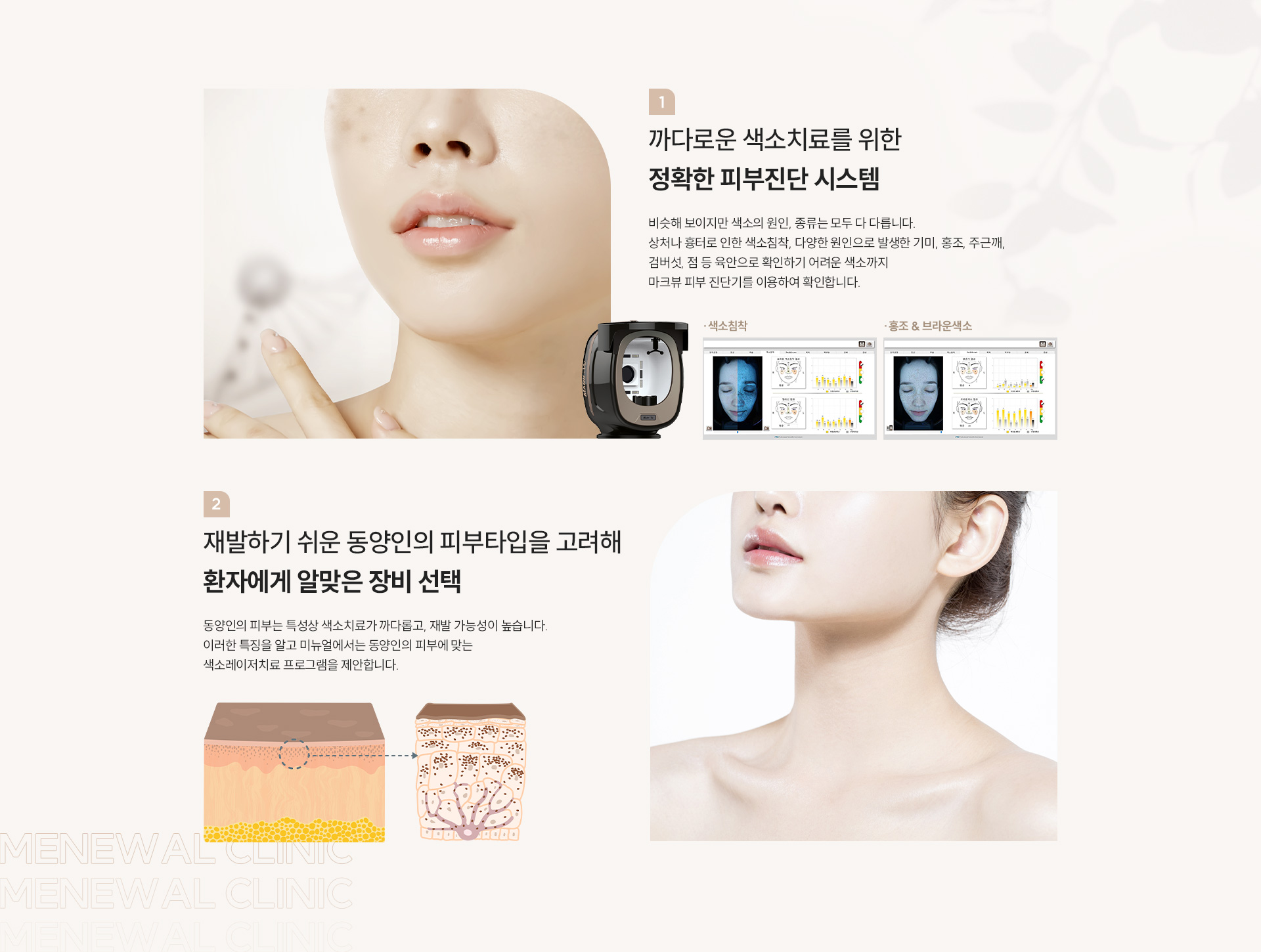 미뉴얼 색소레이저 체크포인트